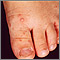 Hand, foot, and mouth disease on the foot