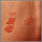 Herpes zoster (shingles) on the back