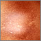 Post-inflammatory hyperpigmentation 2