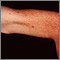 Telangiectasias - upper arm