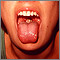 Mononucleosis - mouth