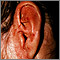 Tinea corporis - ear