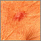 Basal Cell Carcinoma - close-up