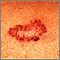 Basal Cell Carcinoma - close-up