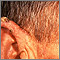 Actinic keratosis - ear