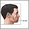 Chin augmentation  - series