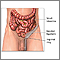 Inguinal hernia repair  - series