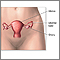 Hysterectomy - series