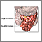 Small bowel resection  - series