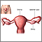 Tubal ligation - series