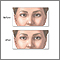 Before and after strabismus repair