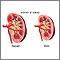 Changes in kidney with age