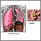 Normal lungs and alveoli