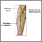 Femoral nerve damage