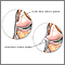 Torn lateral collateral ligament