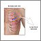 Incision for lung biopsy