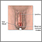 Meatal stenosis