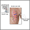 Incision for pleural tissue biopsy