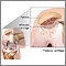 Chondromalacia of the patella