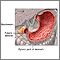 Pyloric stenosis