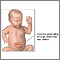 Infant abdominal hernia (gastroschisis)