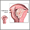 Endometrial cancer