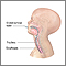 Endotracheal intubation