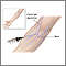 Intravenous pyelogram