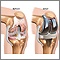 Knee joint replacement prosthesis