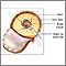 Craniotomy for cerebral shunt