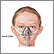 Nasal CPAP