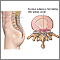 Herniated nucleus pulposis