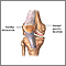 Patellar dislocation