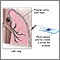 Pleural smear