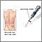 Bone biopsy