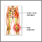 Sciatic nerve damage