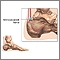 Retrocalcaneal bursitis