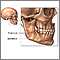 Mandibular fracture