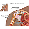 Inflamed shoulder tendons