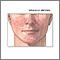 Sebaceous adenoma