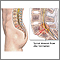 Spinal stenosis