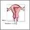 Transvaginal ultrasound